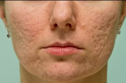 Roaccutane nədir və siz onunla müalicə edirsinizmi? Dermatoloq Həkim Dr.Mehdi Mahmudi