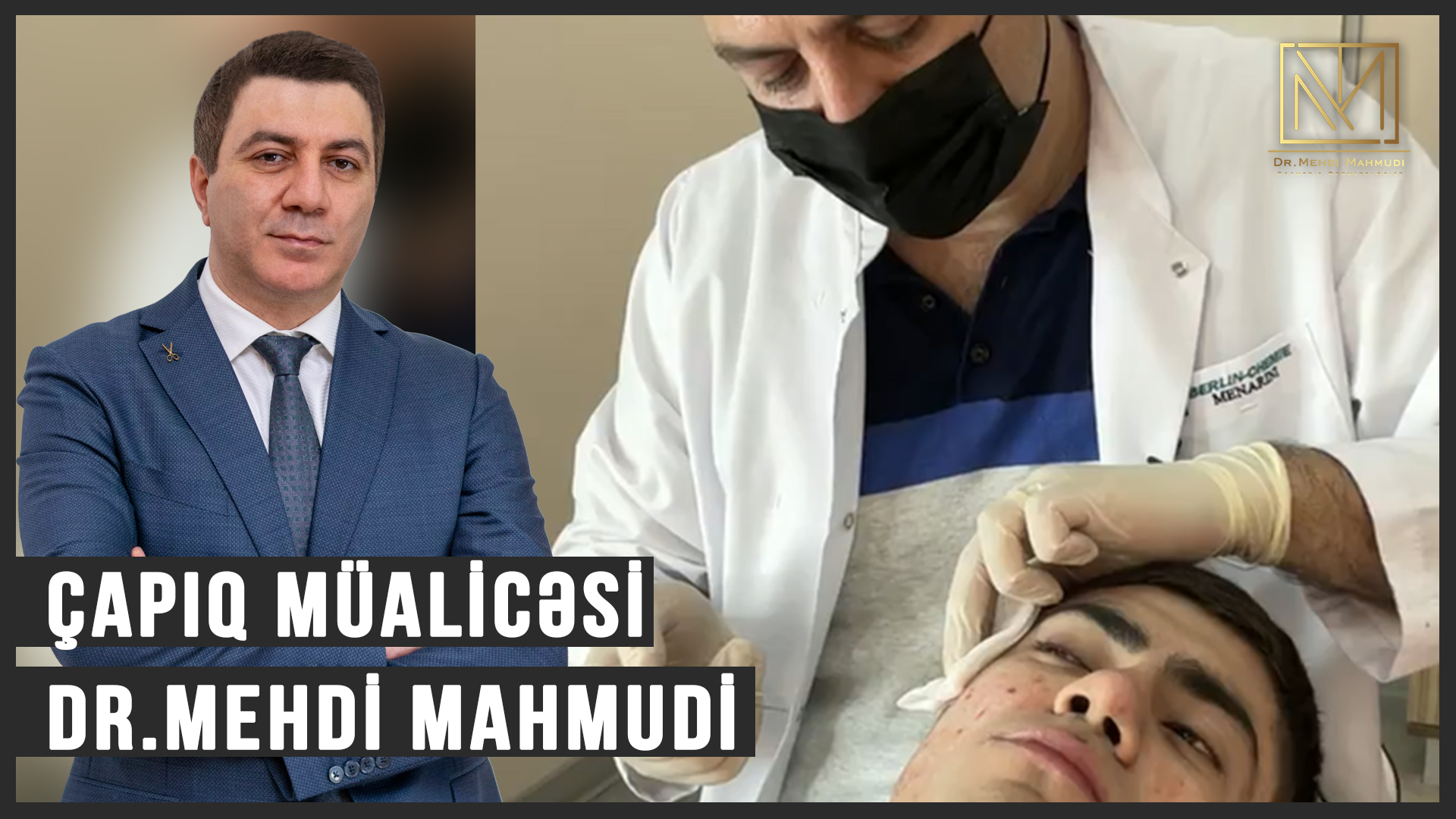 Üzdəki Çapıq Müalicəsi / Canlı yayında capıq mualicesi / Dermatoloq Dr Mehdi