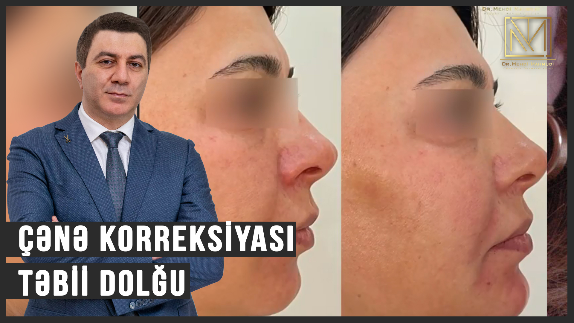 Çənə Korreksiyası / Təbii Dolğu / Dr Mehdi