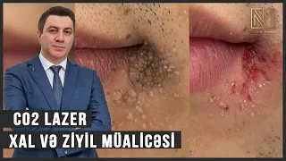 Co2 Lazer; Xal və Ziyil Müalicəsi - Dermatoloq Dr.Mehdi